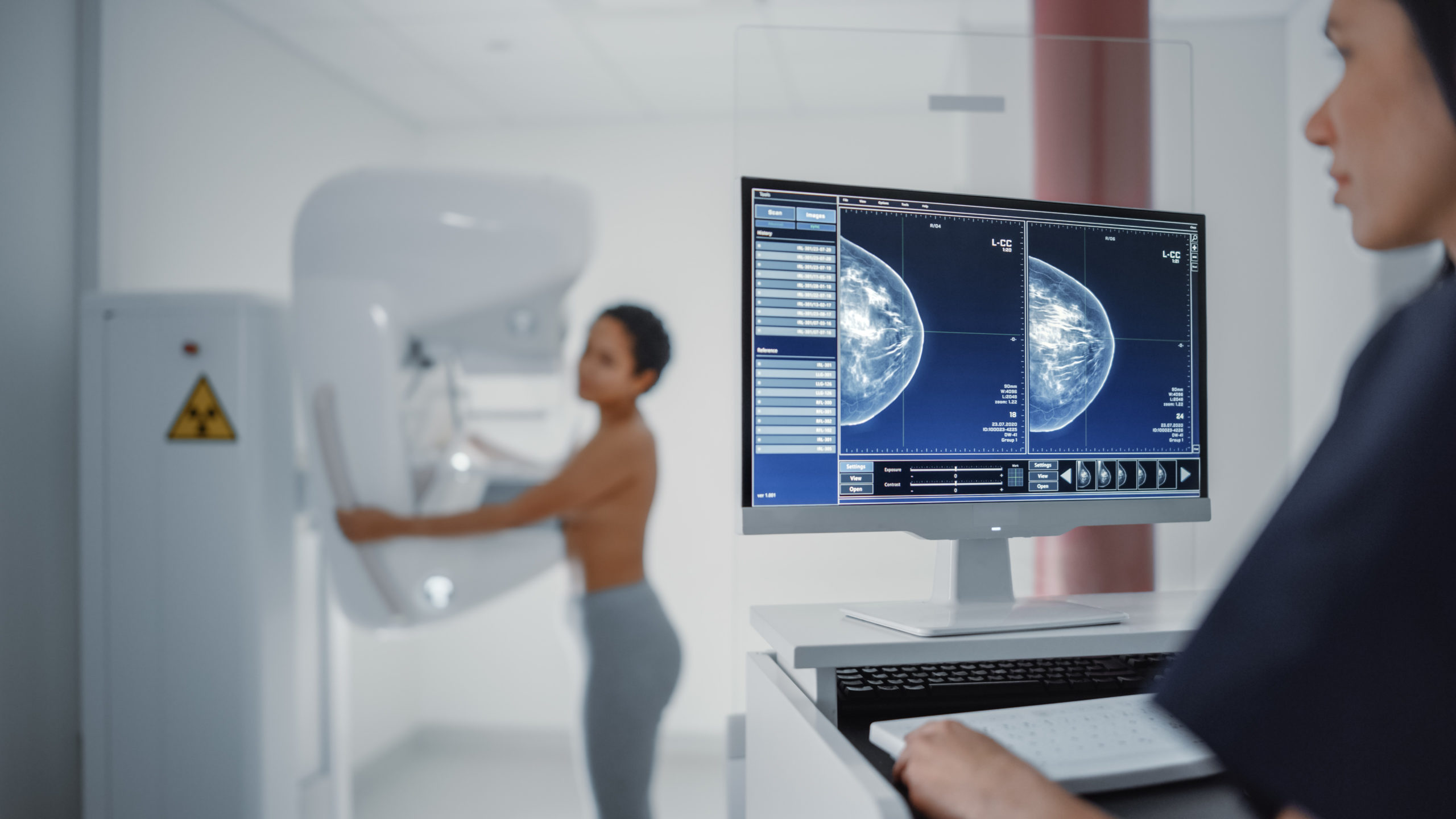 Computer Screen in Hospital Radiology Room: Beautiful Multiethnic Young Woman Standing Topless Undergoing Mammography Screening Procedure. Screen Showing the Mammogram Scans of Dense Breast Tissues.